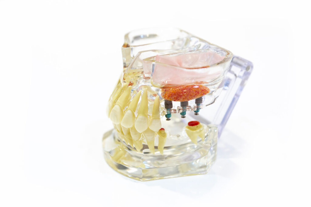 부평 뼈이식임플란트