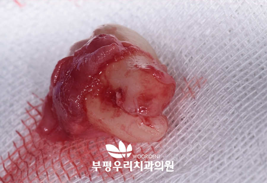 발치 후 주의해야 할 부작용들