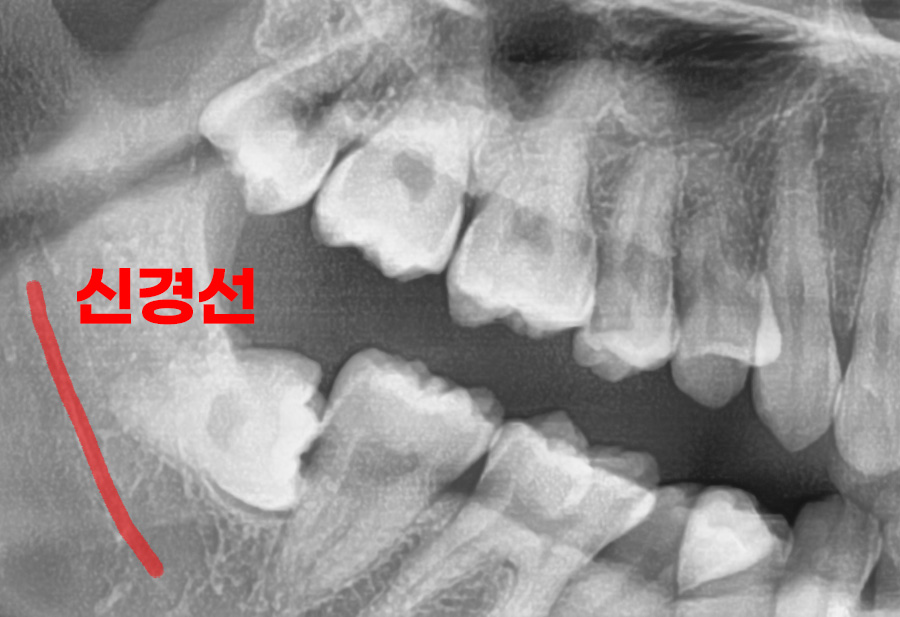 사랑니발치후부작