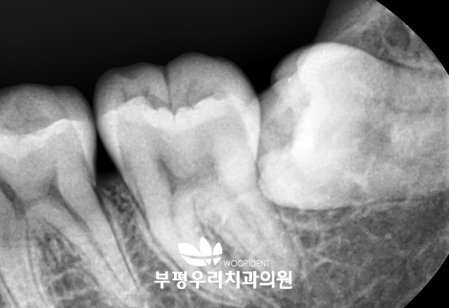 사랑니발치시기를 판단하기 전에 알아야 할 기본 정보