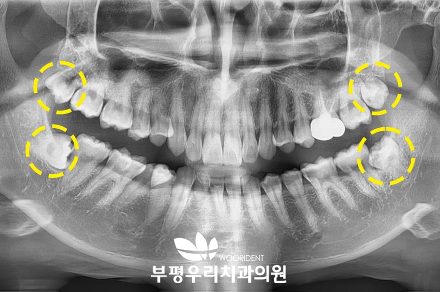 사랑니 발치 후 부작용 FAQ