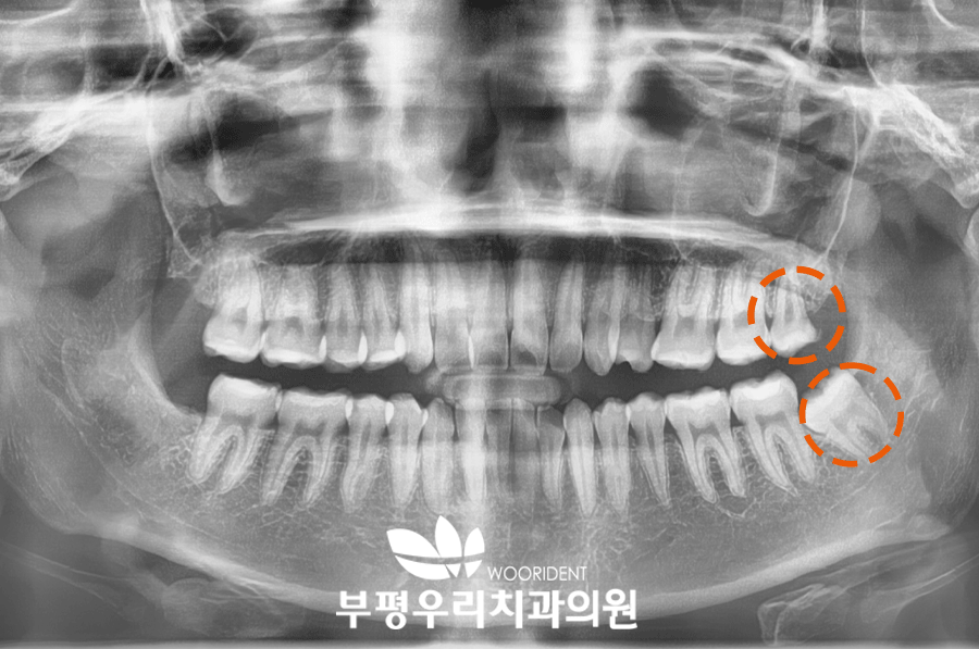 부평구청역 치과에서의 실제 사례